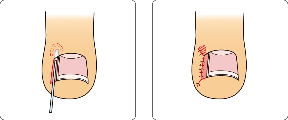 図５　陥入爪の手術