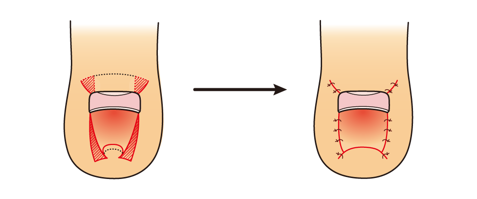 図６　巻き爪の手術（爪を残す方法）